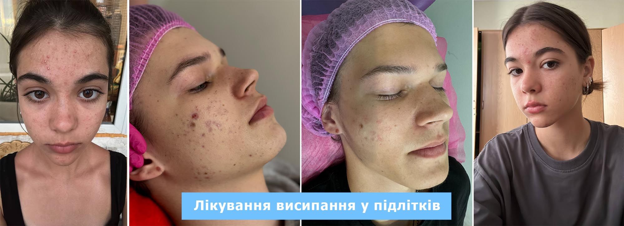 Лікування висипання у підлітків Академмістечко, метро Житомирська